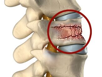 As causas da dor nas costas podem ser doenças da coluna vertebral e discos intervertebrais. 