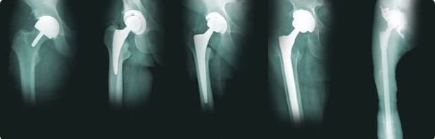 opções para substituição do quadril na artrose