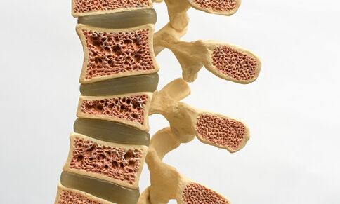 A osteoporose é uma das causas da dor lombar
