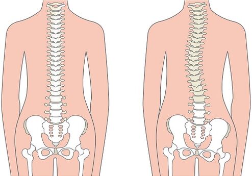 Dor lombar devido a deformidade da coluna vertebral, como escoliose