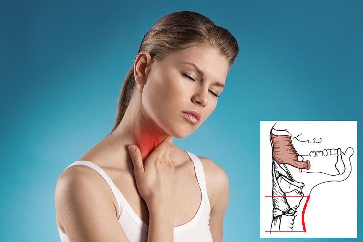 Dor de garganta com osteocondrose cervical devido à compressão nervosa