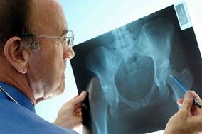 Artrose da articulação do quadril na raio x