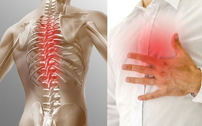 Osteocondrose torácica e dor no peito