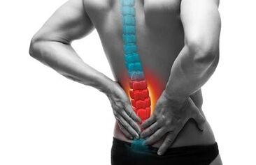 A osteocondrose é uma doença da coluna