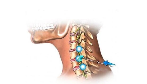 osteocondrose da coluna cervical