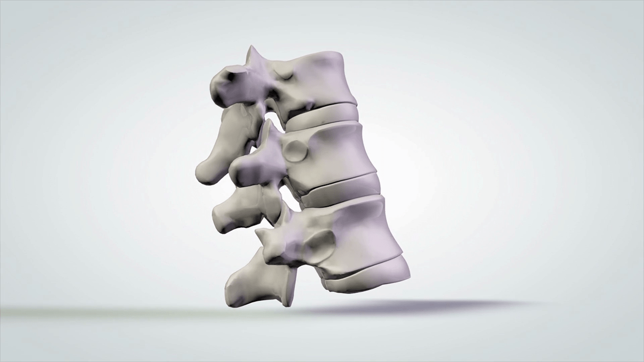 danos à coluna devido à osteocondrose cervical