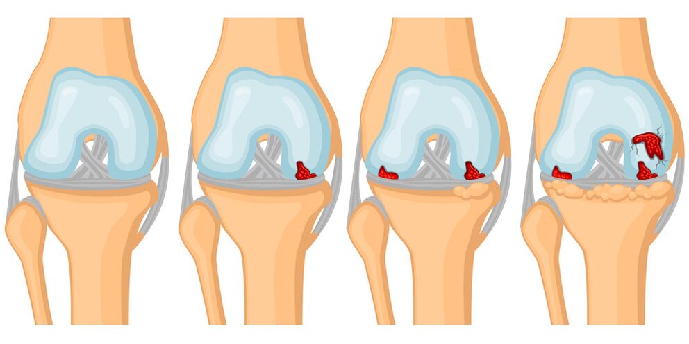 Grau de desenvolvimento de artrose articular