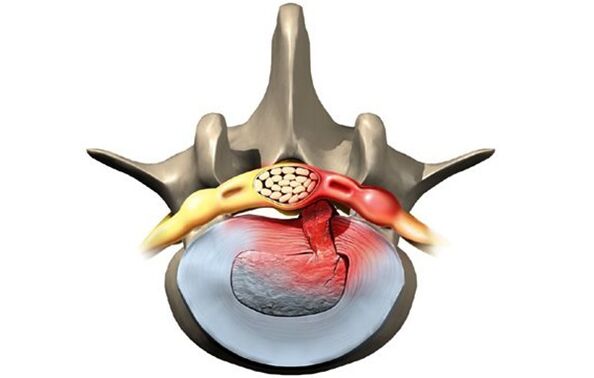 vértebra afetada pela osteocondrose