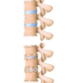 causas da osteocondrose